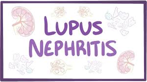 تشخیص آزمایشگاهی بیماری نفریت لوپوسی  (LN: lupus nephritis)