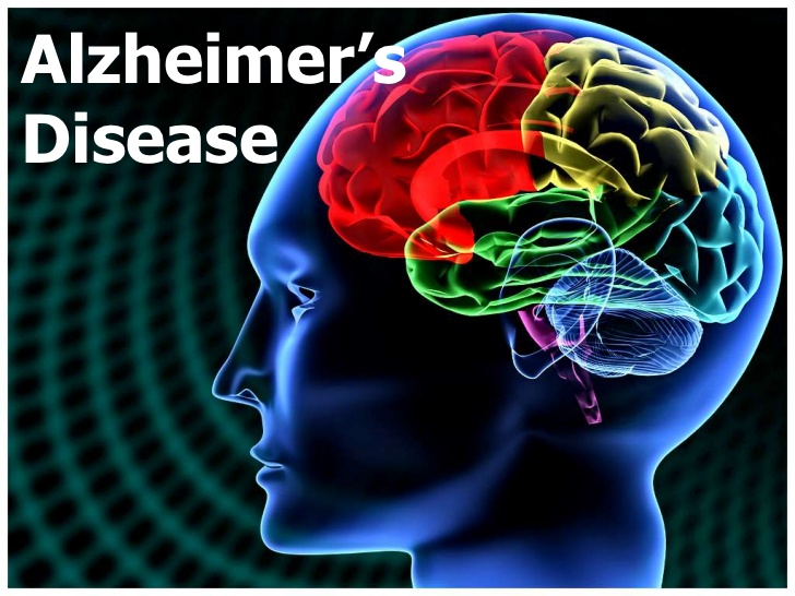  تشخیص ایمونولوژیک بیماری آلزایمر