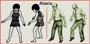 مشاوره ژنتیکی آتاکسی ارثی (Hereditary Ataxia)