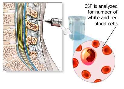 آزمایش و روش نمونه گیری از مایع مغزی نخاعی (CSF)