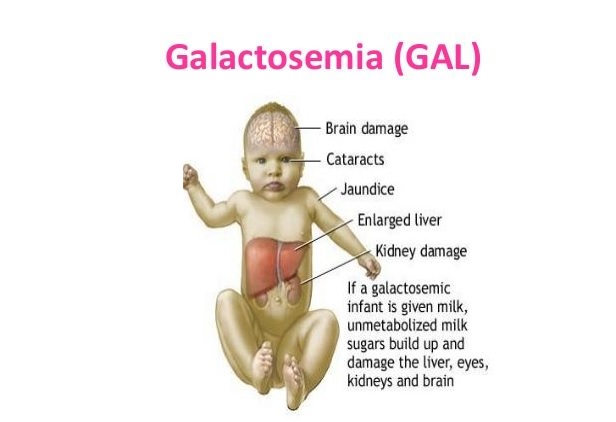 گالاکتوزمی کلاسیک (Classical galactosemia, GALT)